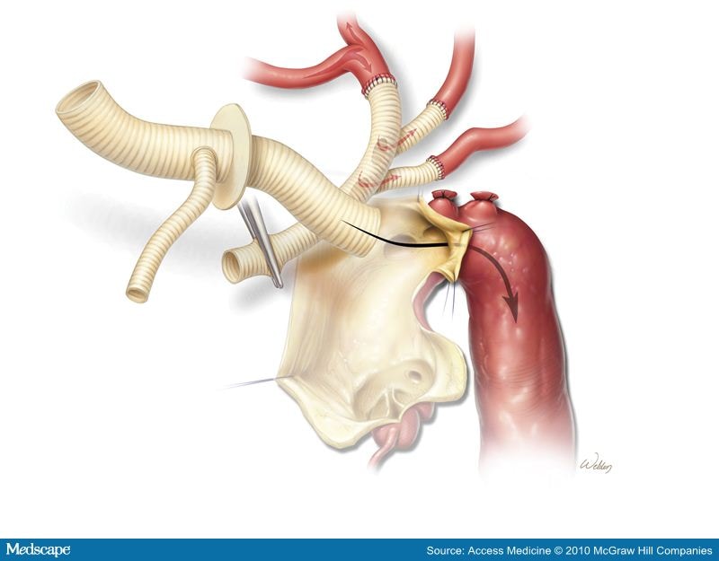 Aortic Dissections and Thoracic Aneurysms - An Update - Page 5