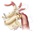 Aortic Dissections and Thoracic Aneurysms - An Update - Page 5