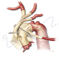 Aortic Dissections and Thoracic Aneurysms - An Update - Page 5