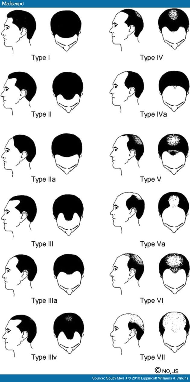 Types of Hair Loss and Treatment Options, Including Low 