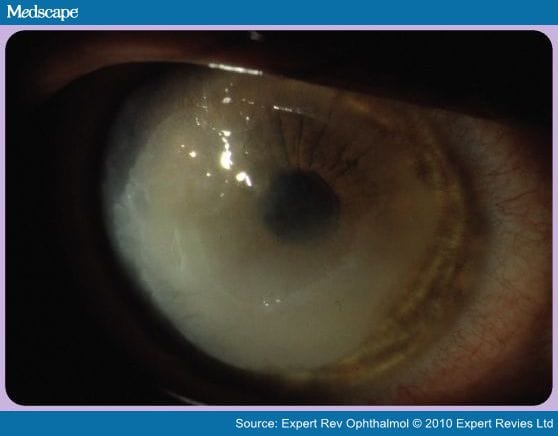 Mechanisms of Corneal Allergic Reaction: New Options for 