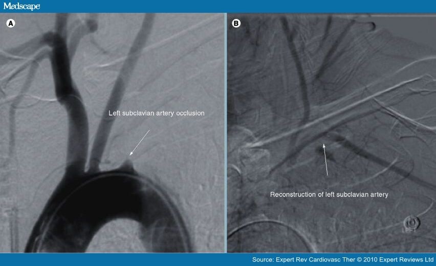 Diagnosis And Treatment Of Subclavian Artery Occlusive Disease - Page 4