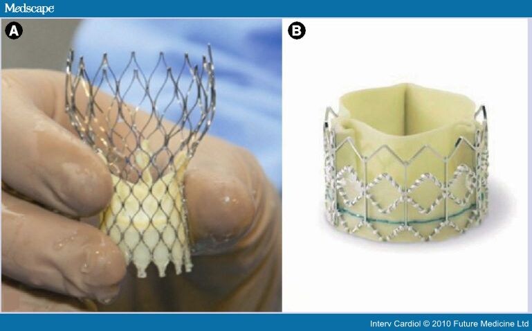 Transcatheter Aortic and Mitral Valve Interventions: Update 2010 - Page 2