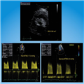 Stress Doppler Echocardiography In Valvular Heart Diseases - Page 3