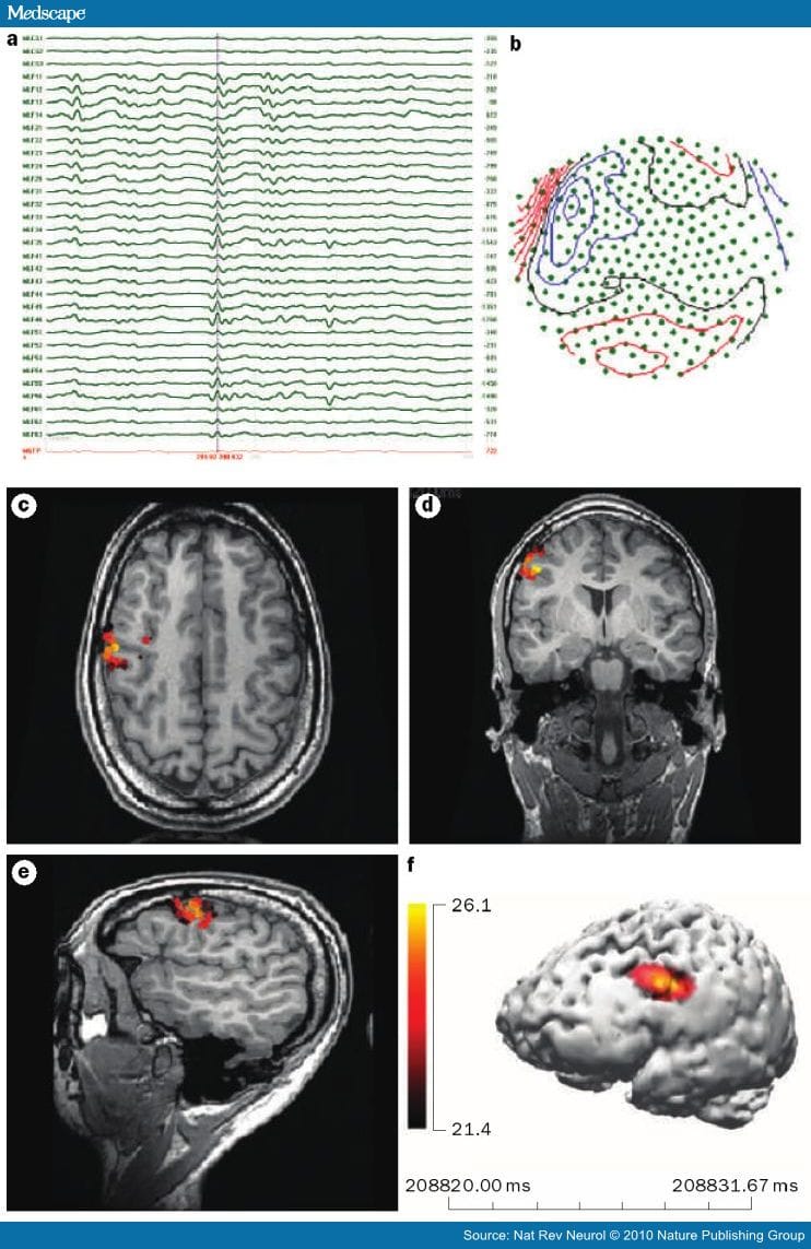 Imaging in the Surgical Treatment of Epilepsy - Page 2