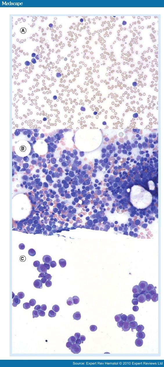 plasma-cell-leukemia-concepts-and-management-page-3
