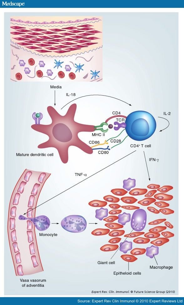 Management of Giant Cell Arteritis and Polymyalgia Rheumatica - Page 7