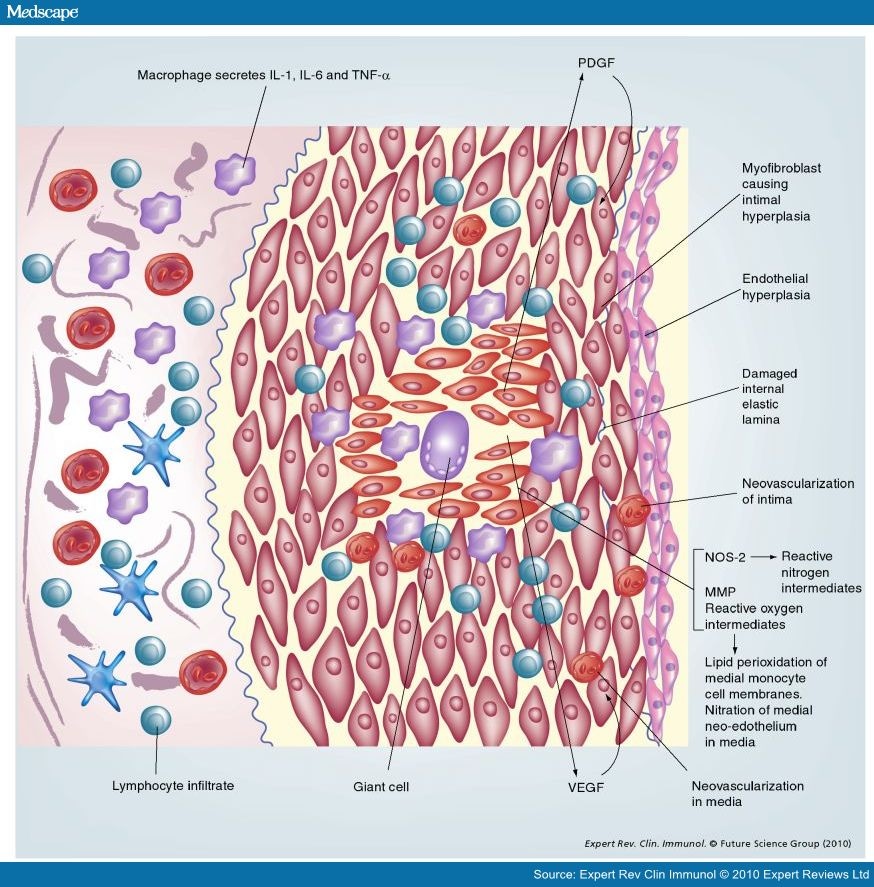 management-of-giant-cell-arteritis-and-polymyalgia-rheumatica