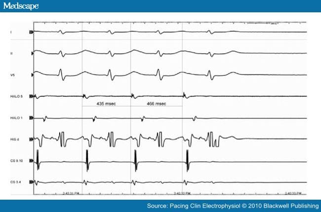 Mapping and Ablation of Atypical AVNRT - Page 2
