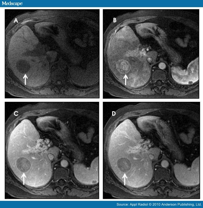 MR Contrast Agents: Applications in Hepatobiliary Imaging