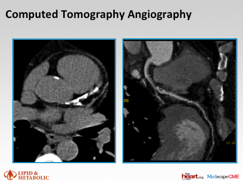 how do you remove calcium plaque from arteries