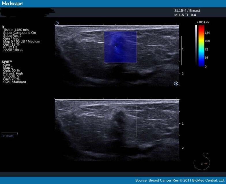 Quantitative Shear Wave Ultrasound Elastography