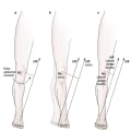 Knee Osteoarthritis: Conservative Biomechanical Strategies