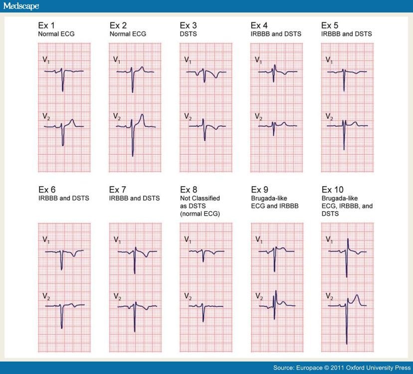 Incomplete RBBB: A Novel ECG Marker for Lone AF