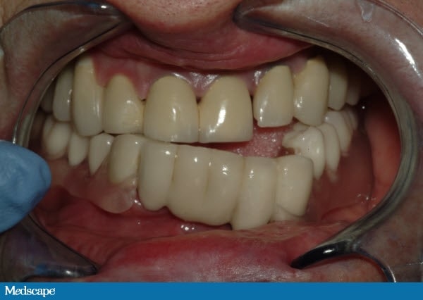 Acromegaly Jaw