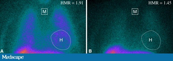 Cardiac Imaging in HF: Sympathetic Neuronal Dysfunction