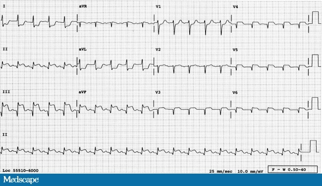 Which Part of the Heart Is Infarcted? Part I