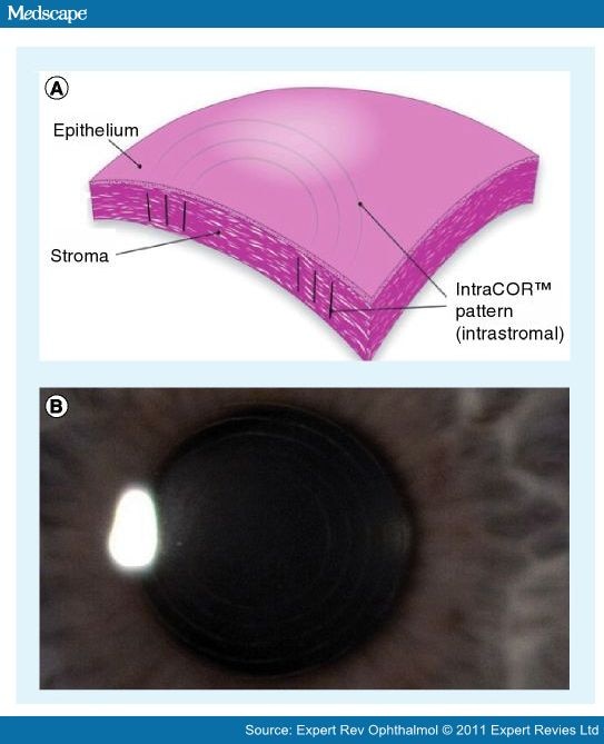 Refractive Surgery: Comparison of Femtosecond Lasers - Page 7