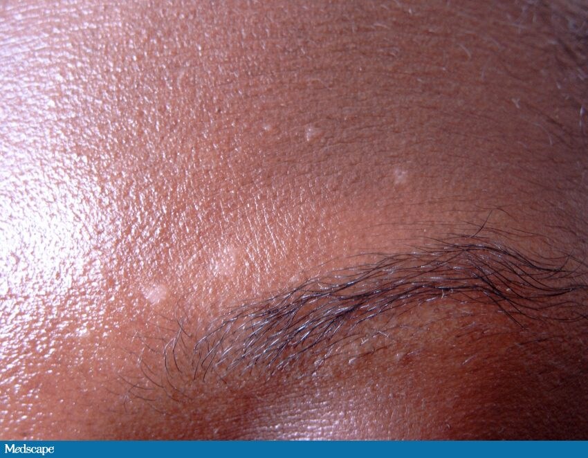 A 27 Year Old Woman With Facial Discoloration