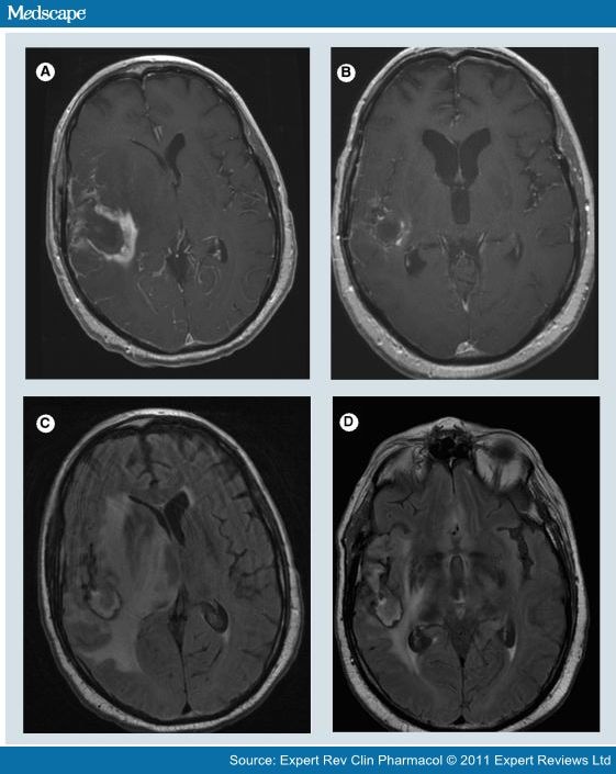 Corticosteroids in Brain Cancer Patients Page 3