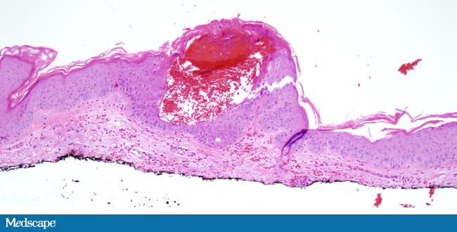 A Post-Stroke Hemorrhagic Rash - Page 2