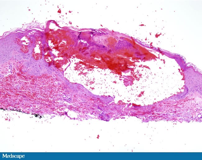 A Post-Stroke Hemorrhagic Rash - Page 2