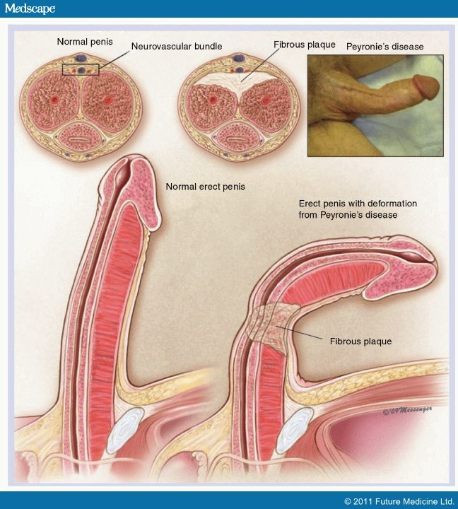 Peyronie's disease deformities. 