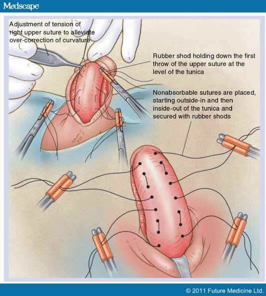 Management of Peyronie's Disease in the Aging Male - Page 6