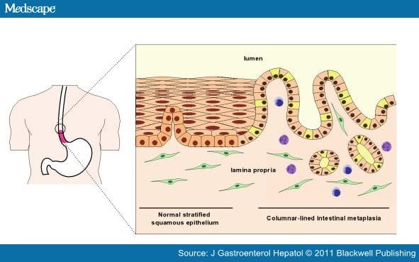 Barrett's Esophagus