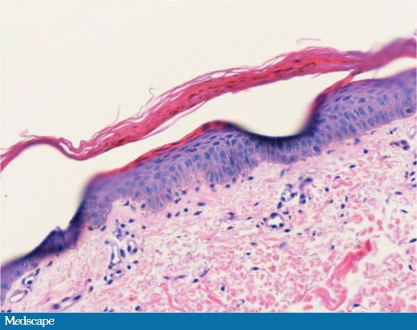 Dermatitis, Diarrhea and Alopecia: What Is Your Diagnosis? - Page 2