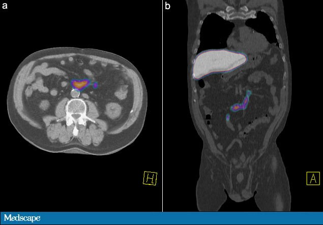 Hybrid Imaging: PET/CT Carries the Load - Page 4