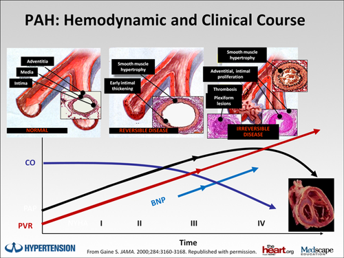 Diagnosis And Treatment Of Scleroderma Related Pah Improving Patient Care And Outlook Transcript 2709