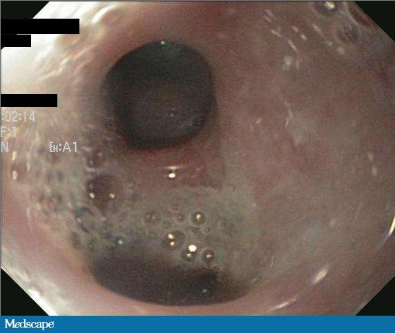 Bronchoesophageal Fistula From Self-Induced Vomiting