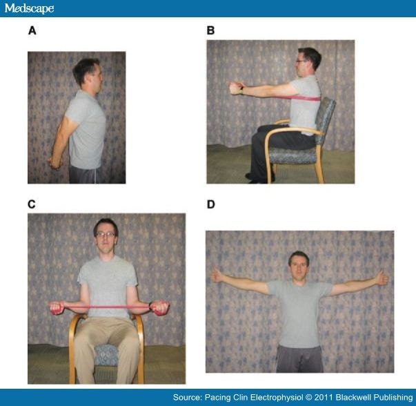 Preventing Shoulder Pain After Cardiac Device Implantation - Page 2