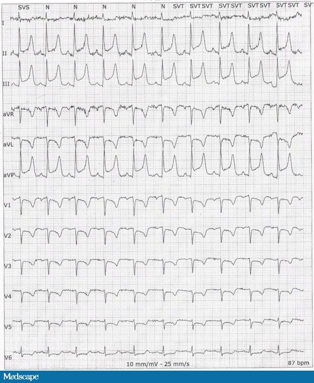 Syncope in a 53-Year-Old With Dyspnea and Morning Chest Pain - Page 3