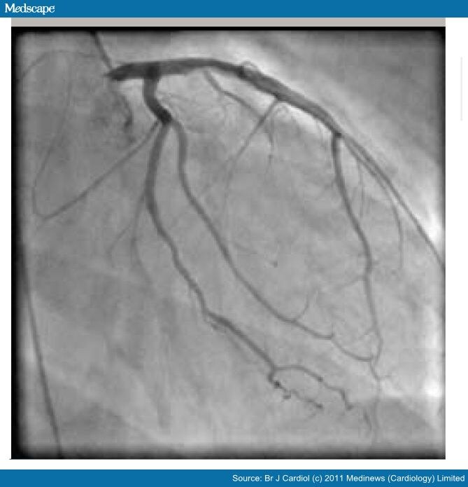 Coronary Artery Dissection Secondary to Cocaine Abuse