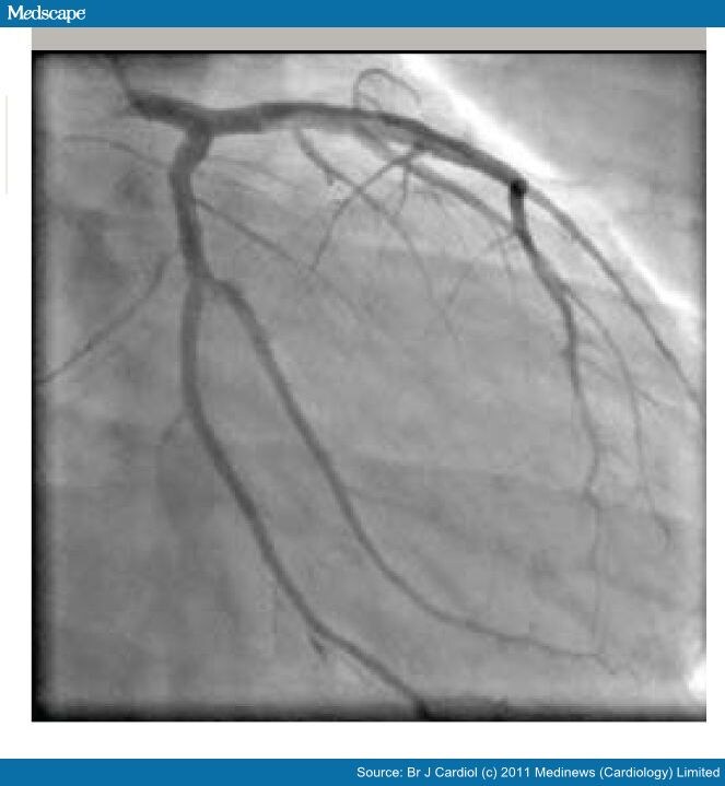 Coronary Artery Dissection Secondary to Cocaine Abuse