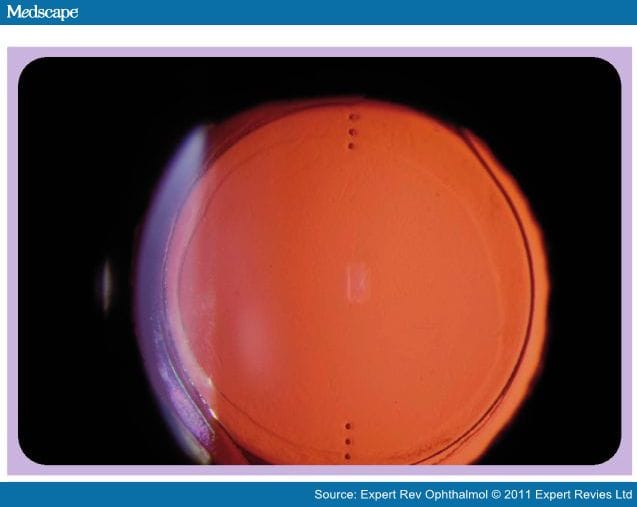 Astigmatism Management at the Time of Cataract Surgery - Page 5