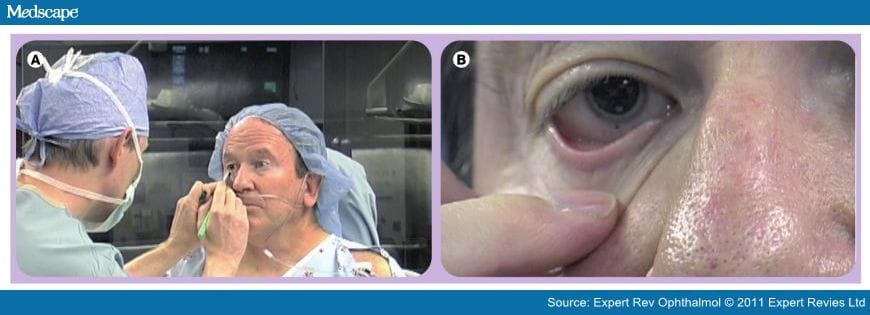 Astigmatism Management at the Time of Cataract Surgery - Page 5