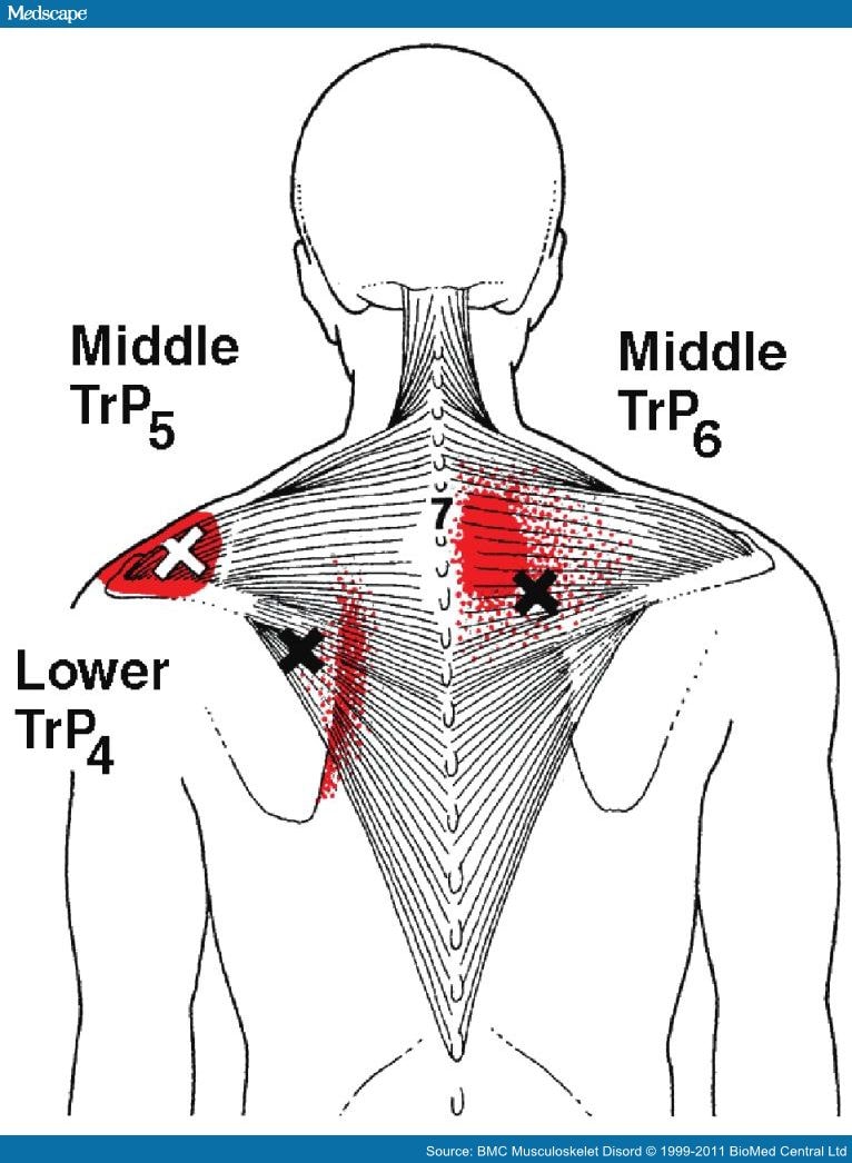 Myofascial Trigger Points In Patients With Shoulder Pain