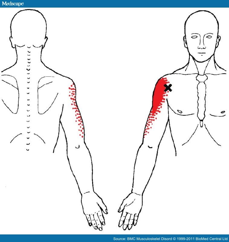 Myofascial Trigger Points in Patients with Shoulder Pain - Page 2