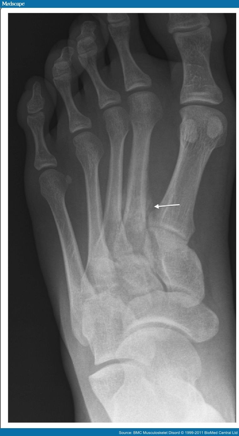 MRI Scanners in Evaluation of Acute Bone Stress in the Foot - Page 3