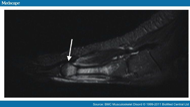 MRI Scanners in Evaluation of Acute Bone Stress in the Foot - Page 4