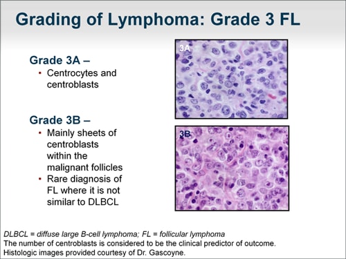 Follicular Lymphoma: Evaluating First-Line Treatment Options (Transcript)