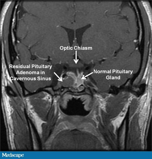 Mini-Case: Signs, Symptoms, And Treatment Of Acromegaly In Adults