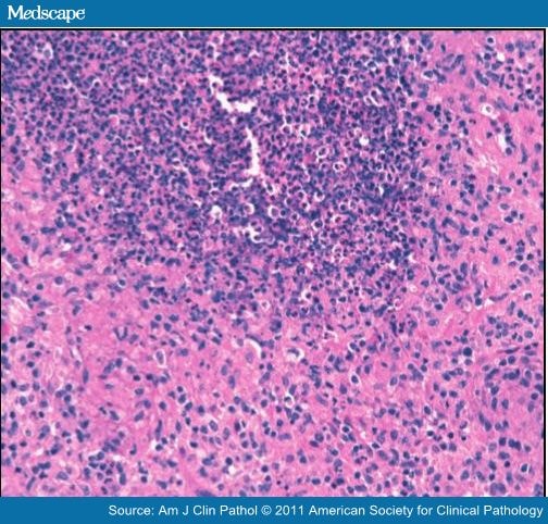 Cystic Neutrophilic Granulomatous Mastitis