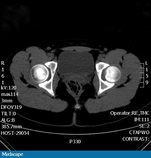 Renal Stones in Kids