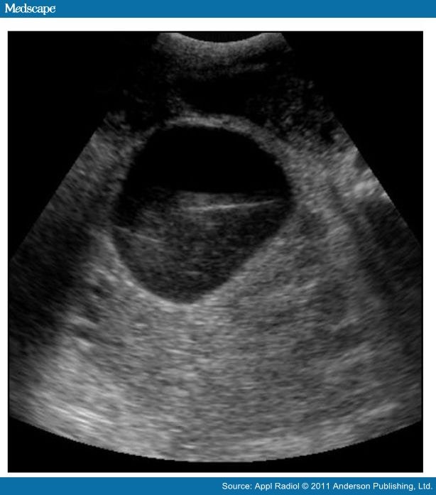 Pseudomyxoma Peritonei Secondary to Mucocele of the Appendix