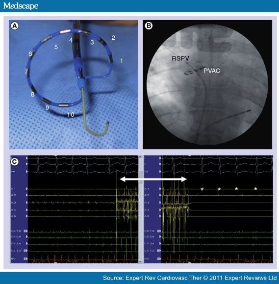Treatment of Persistent AF Using Phased RFA - Page 3