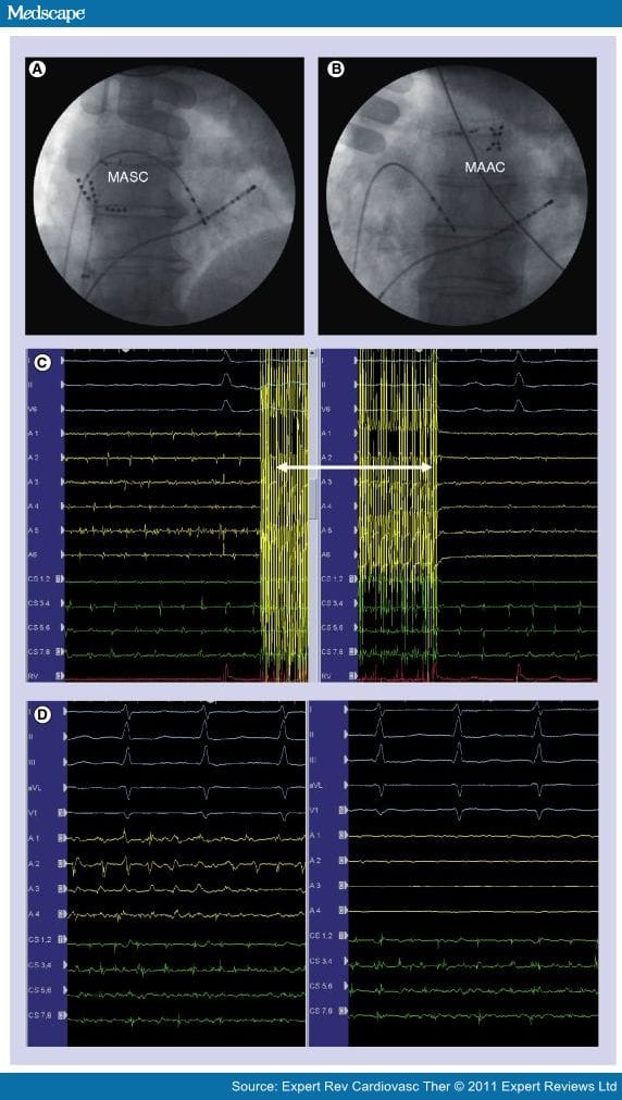 Treatment of Persistent AF Using Phased RFA - Page 3